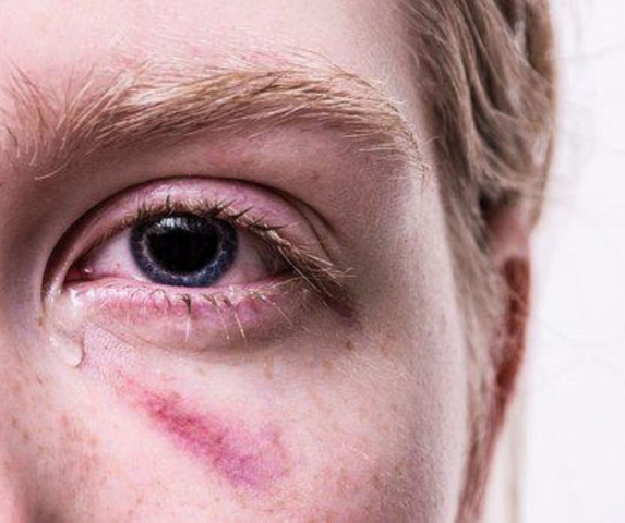 Teen Dating Violence